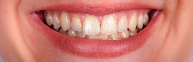 Dentes antes do tratamento, medicina dentaria